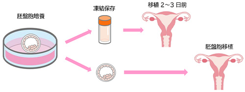 子宮内膜刺激術